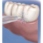 Waterpik - Bico Jato Clássico - 02 unidades