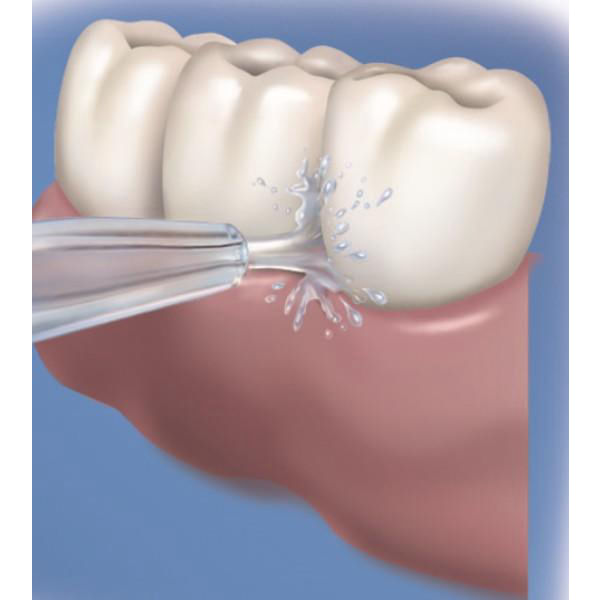 Waterpik - Bico Jato Clássico - 02 unidades